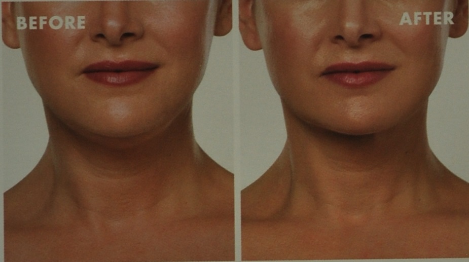 Treatment for double chin - before and after